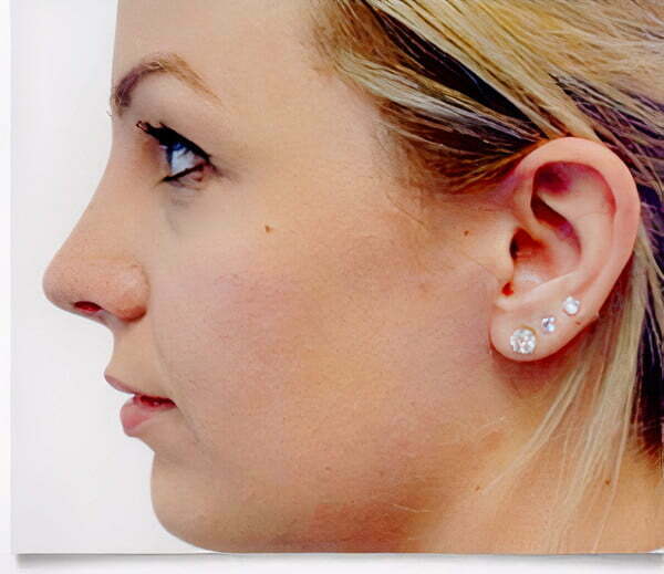 rhinoplasty-blonde-after-2021