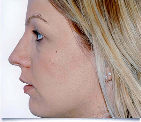 rhinoplasty-blonde-before-2021
