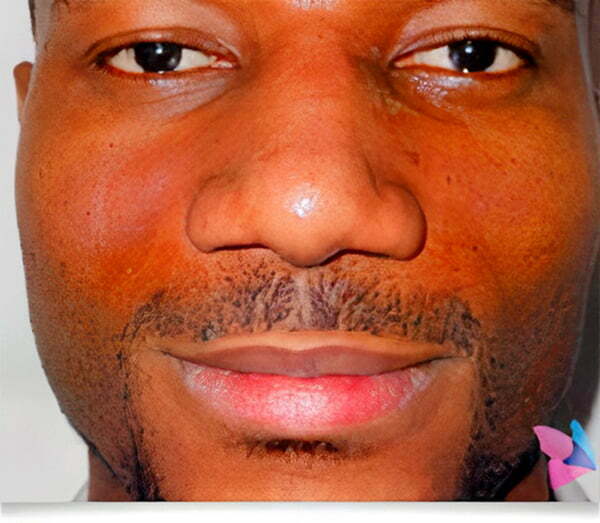 rhinoplasty-man-after-2021