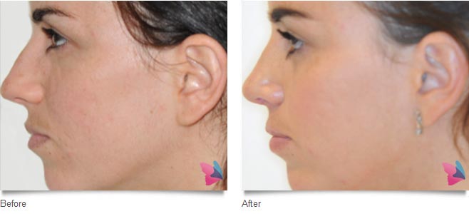 rhinoplasty before and after photo