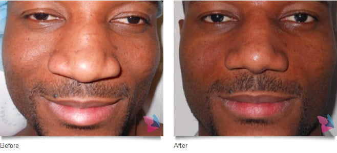 rhinoplasty before and after photo