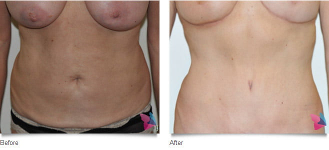 tummy_tuck_before_and_after_photo
