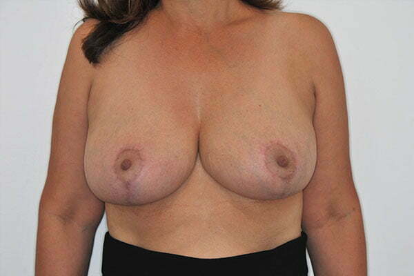 kj-breast-reduction-2b