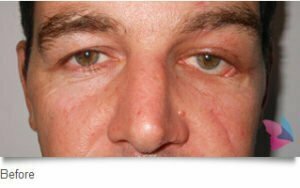nose job sydney