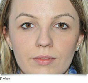 rhinoplasty woollahra