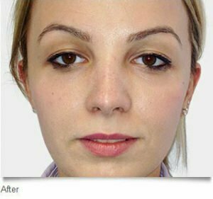 rhinoplasty sydney