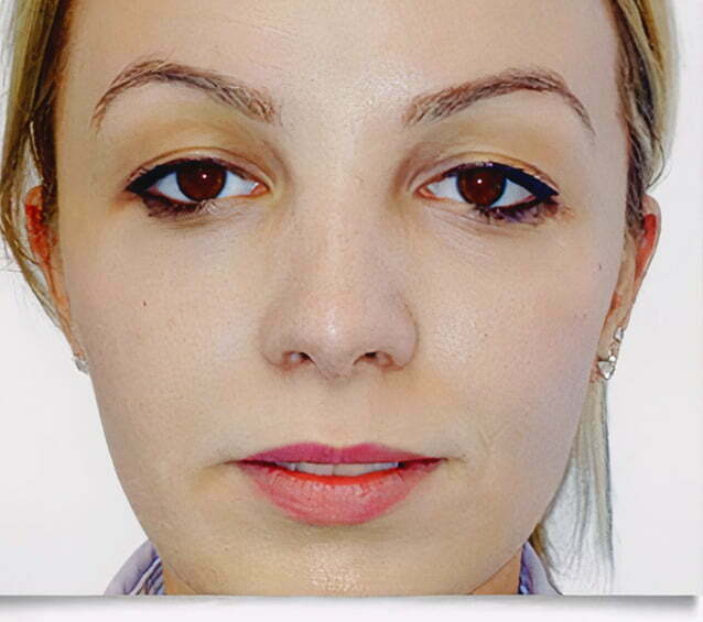 rhinoplasty-blonde-2-after-1