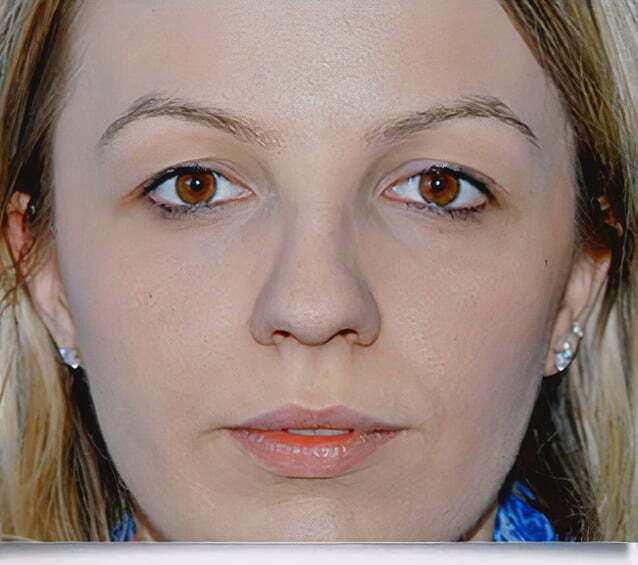 rhinoplasty-blonde-2-before-1