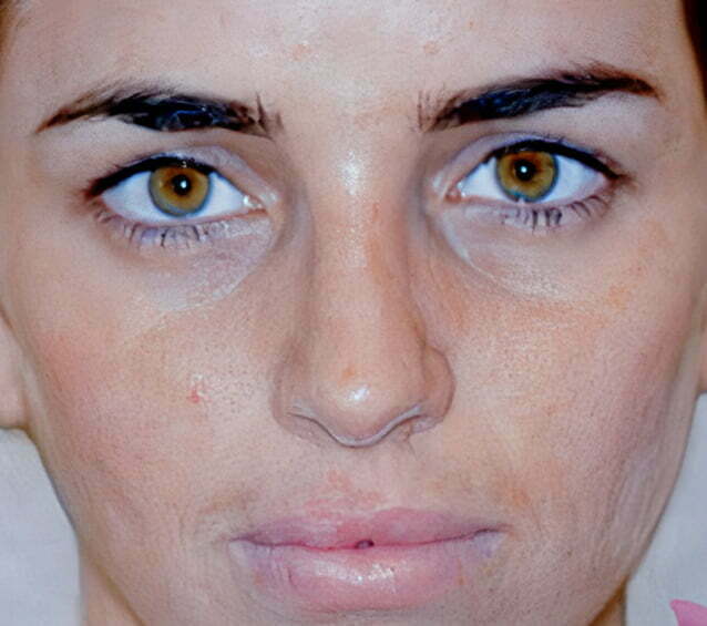 rhinoplasty-brunette-2-after