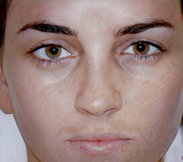 rhinoplasty-brunette-2-before