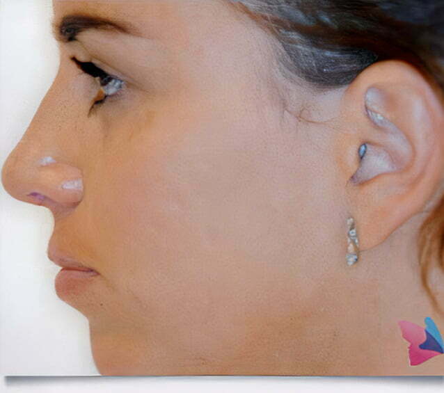 rhinoplasty-brunette-after