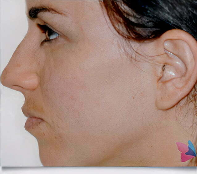 rhinoplasty-brunette-before